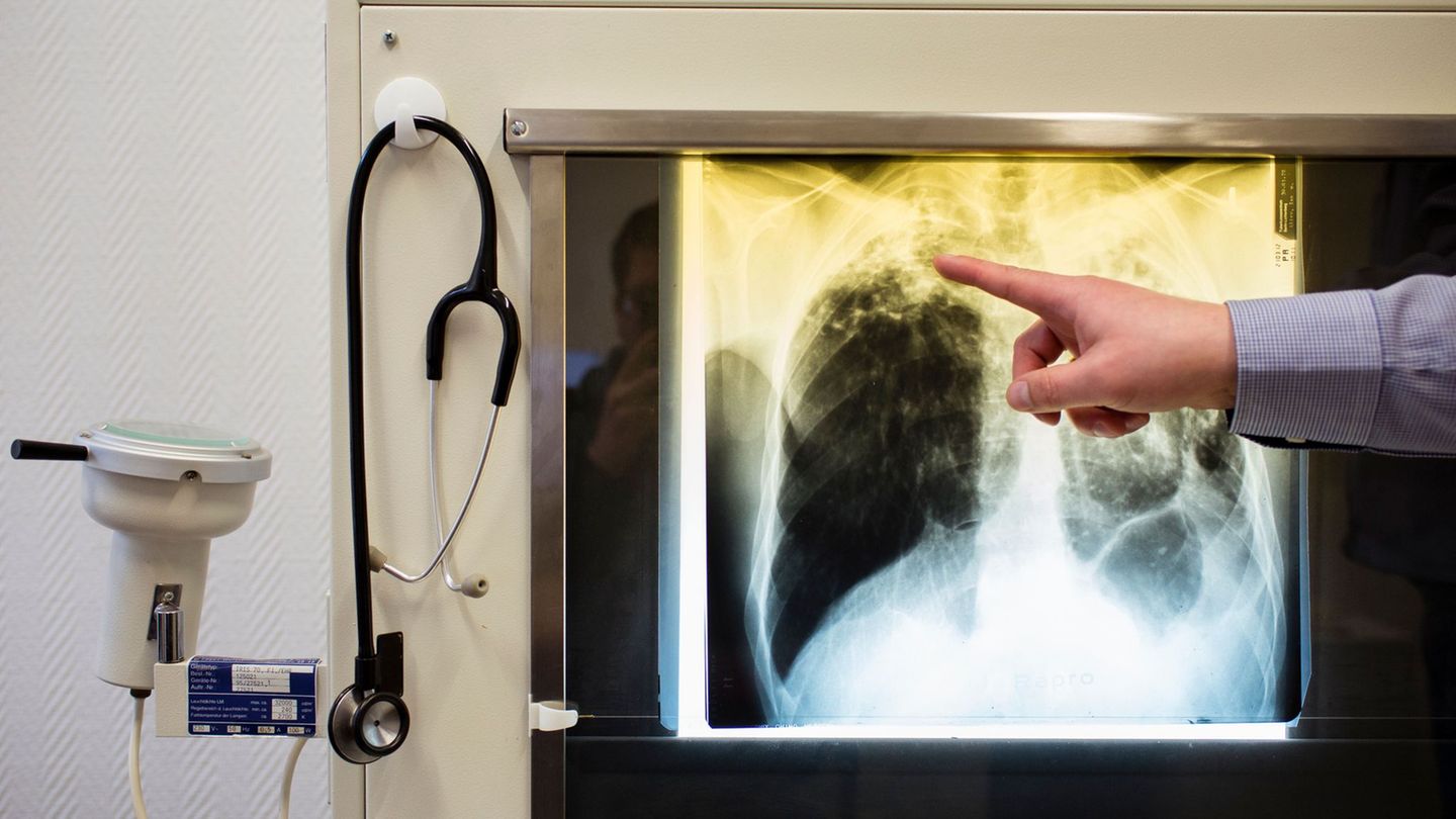 Infektionen: Köpping: Tuberkulose-Prävention weiter sehr wichtig