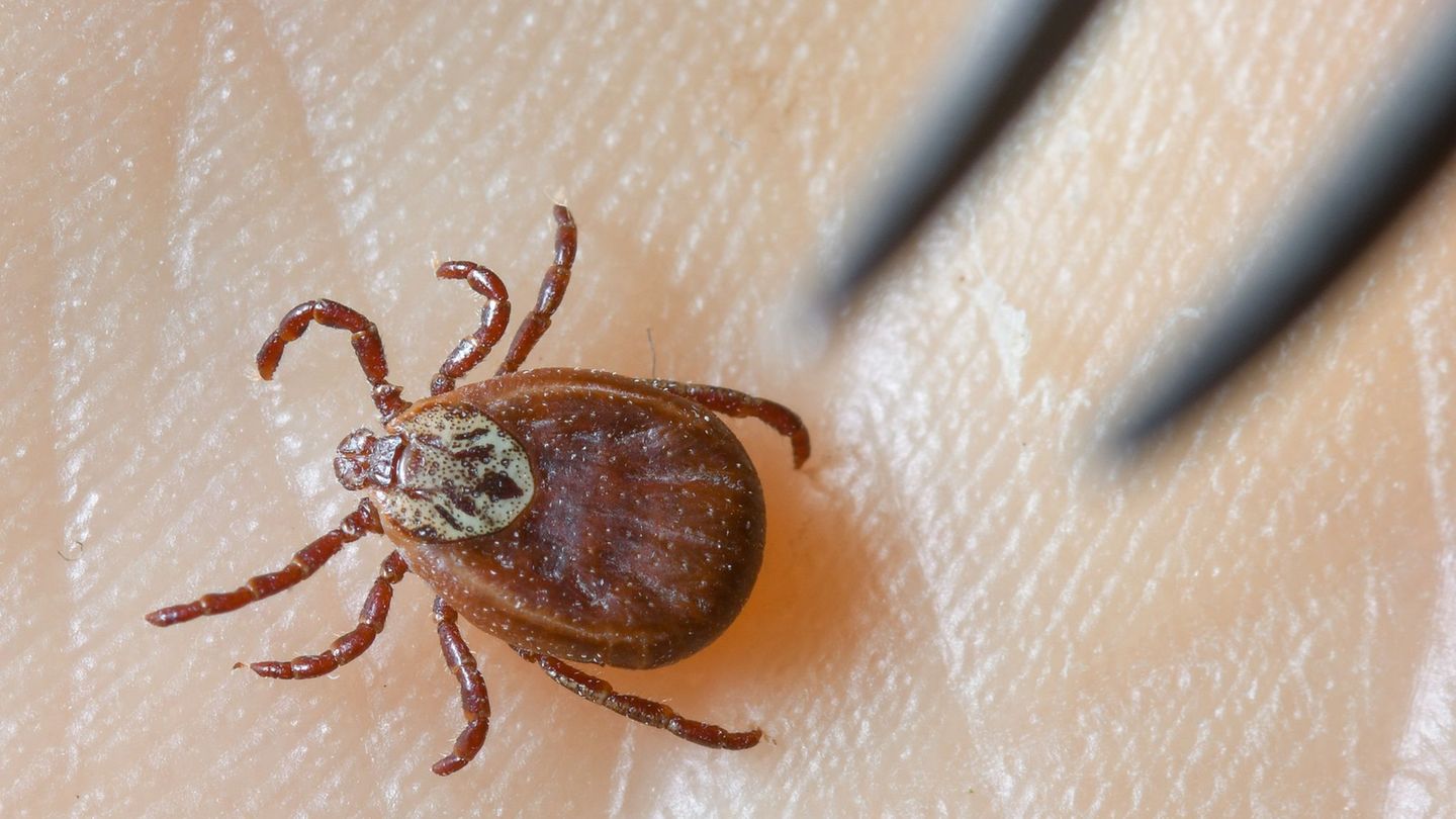 Krankheiten: Nach Zeckenbiss: Mehr Borreliose-Fälle in MV als im Vorjahr